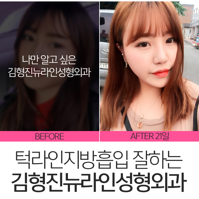턱라인지방흡입 김형진원장이 체고야! 관련 이미지 9