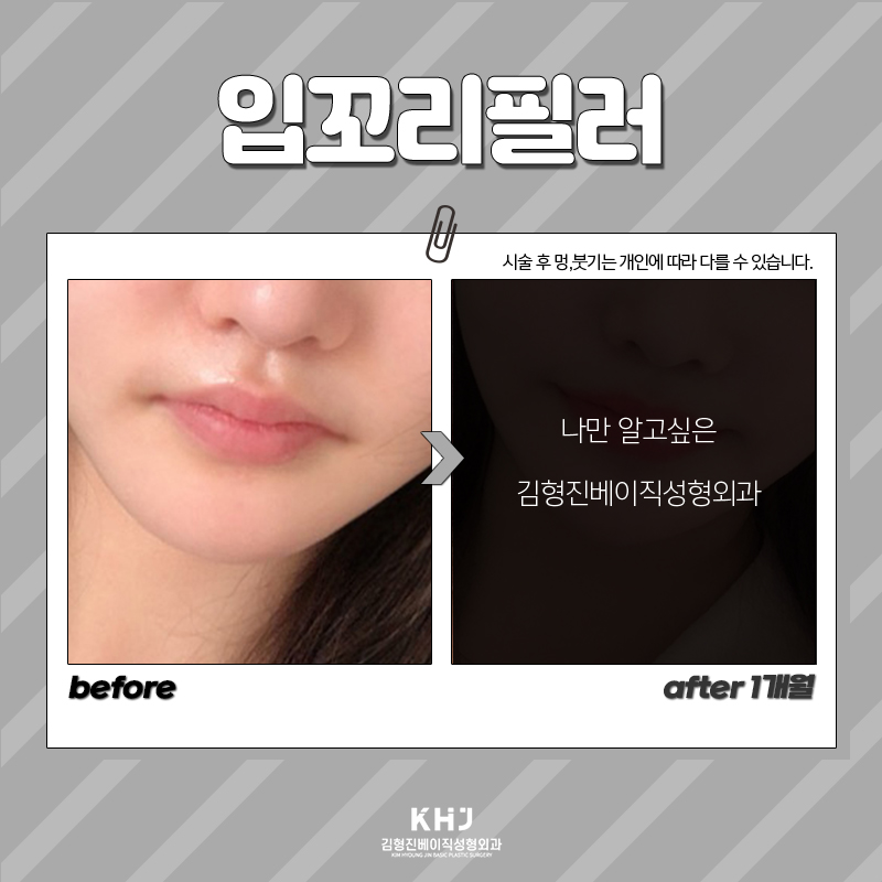 입꼬리에 진심인 김형진베이직의 리얼한 입꼬리필러후기 관련 이미지 5