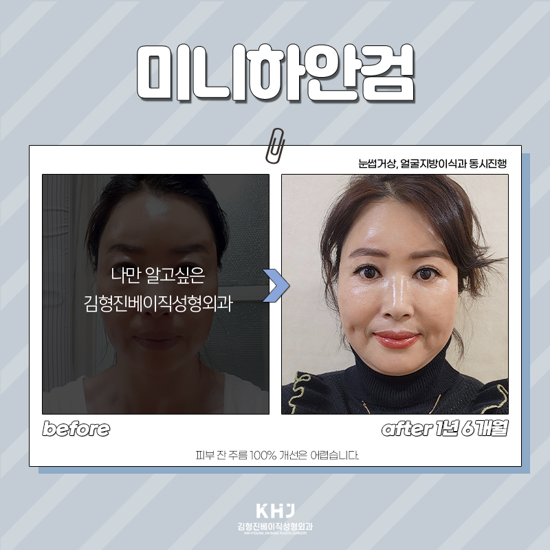 중년눈밑처짐 개선방법 알려드려요! 관련 이미지 5