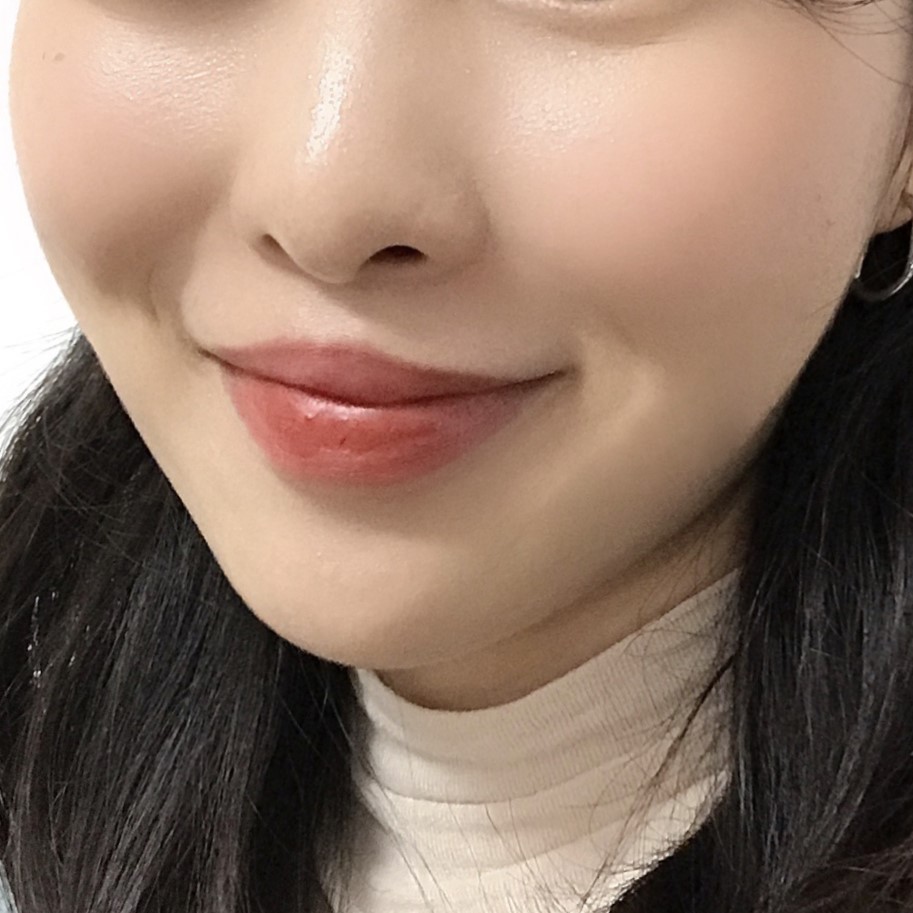 입꼬리시술로 자연스러운 미소라인 만드는 법 관련 이미지 2