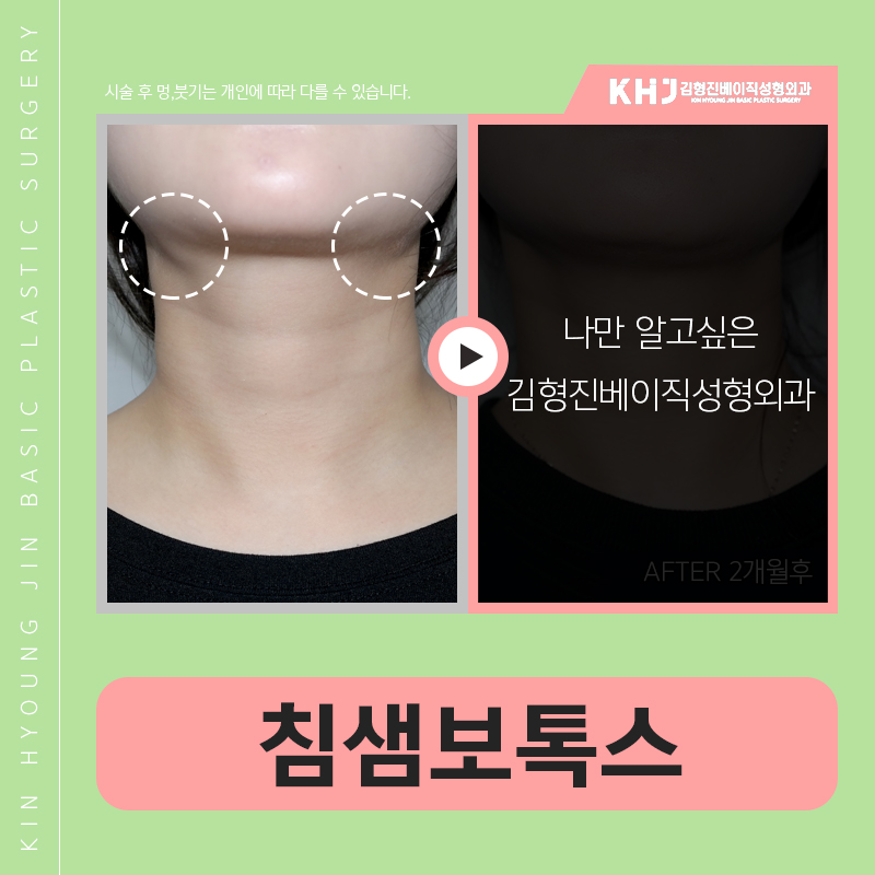침샘보톡스 하나로 두턱없애기 관련 이미지 3