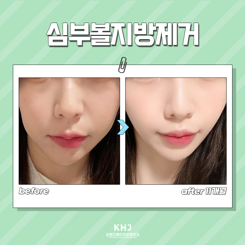 불독살없애는법 찾고 있다면? 김형진베이직의 심부볼지방제거로 매끄럽게 변신! 관련 이미지 5