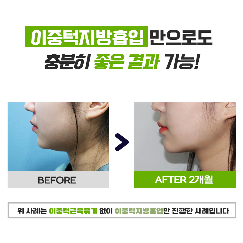 이중턱살빼는법 더이상 고민할 필요가 없는 이유 관련 이미지 7