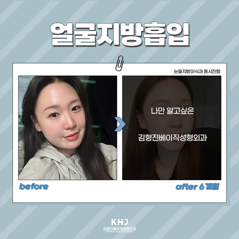 얼굴지흡후기 확인하고 가실 분~! 관련 이미지 5