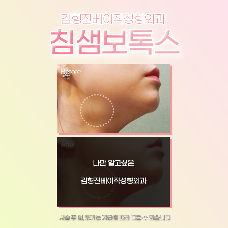 침샘보톡스효과 볼 수 있는 곳에서 하셔야죠 관련 이미지 3