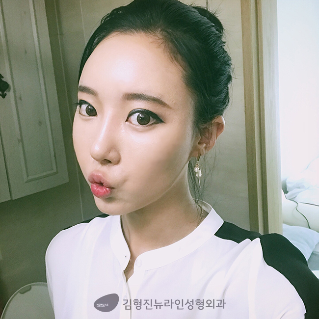 입꼬리수술비용 보다 효율적인 방법은? 관련 이미지 2