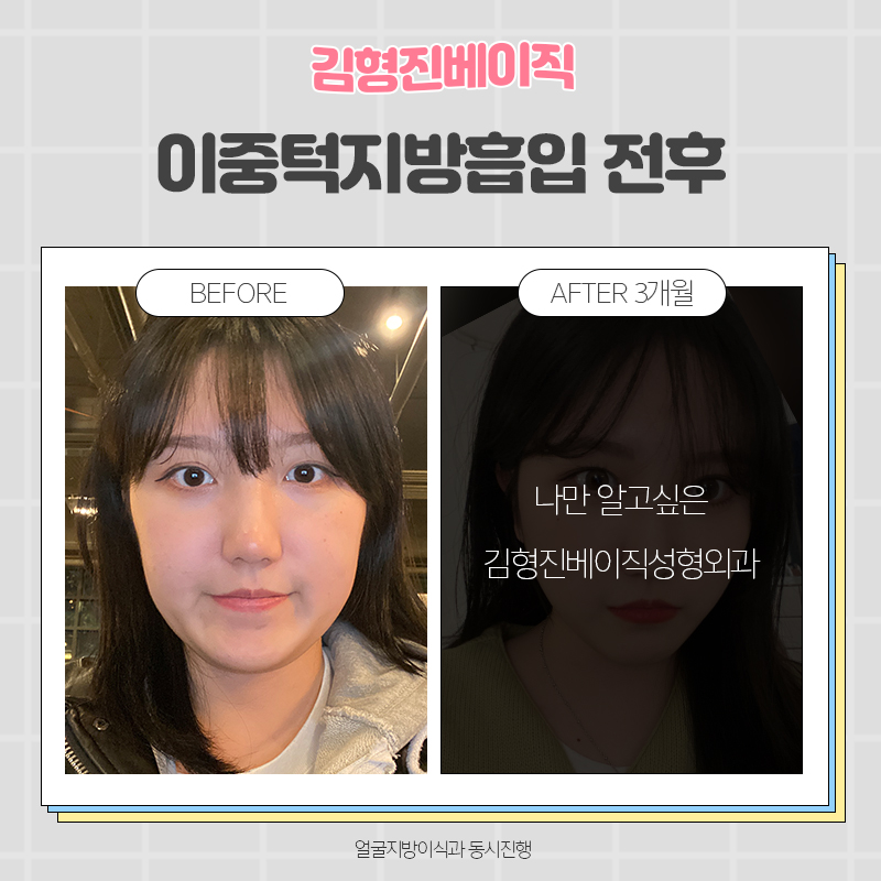 턱살흡입전후 궁금하다면 여기로! 관련 이미지 4