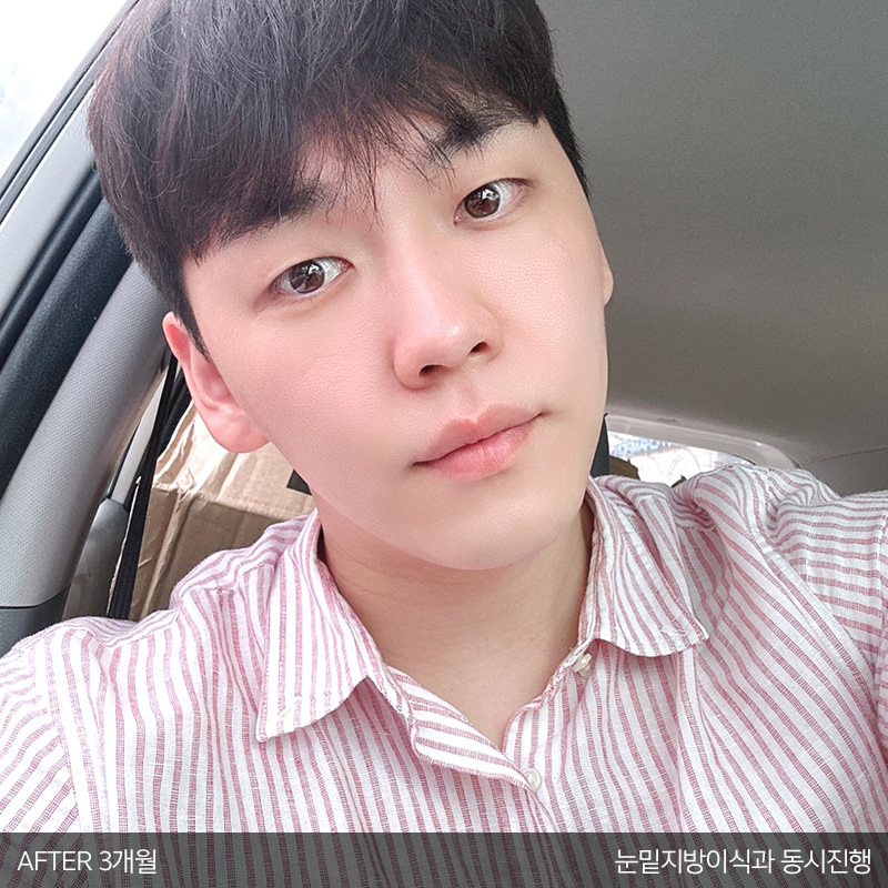 눈밑지방재배치수술효과 모르시는분! 관련 이미지 5