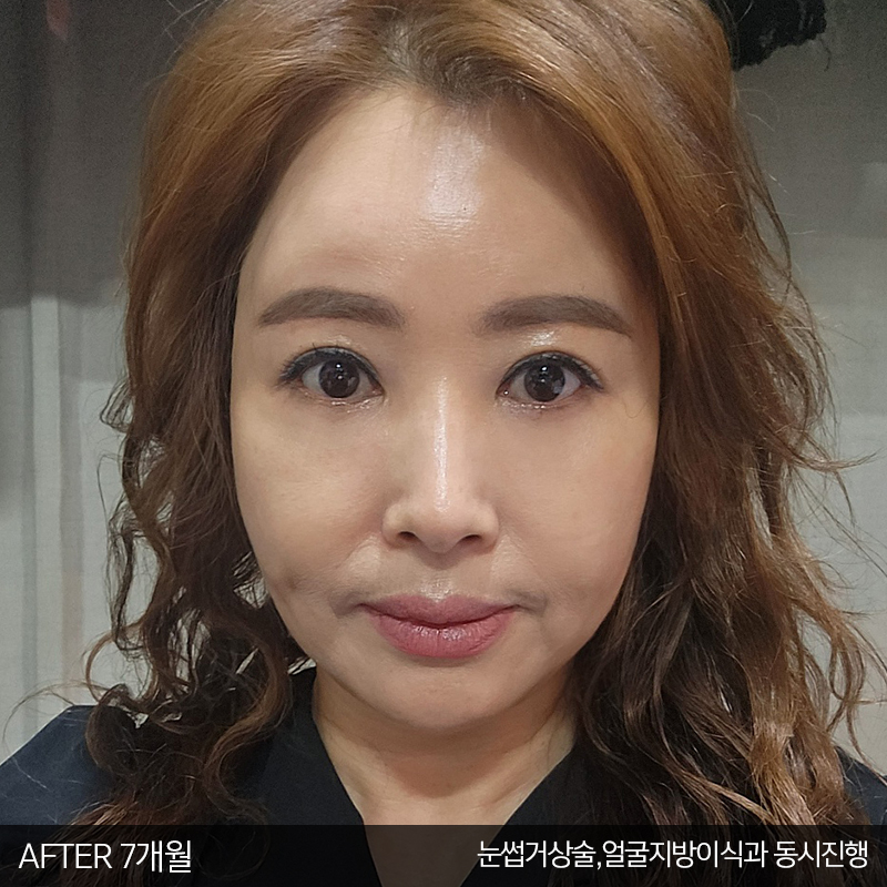 중년눈밑수술 잘하는 김형진베이직 관련 이미지 6