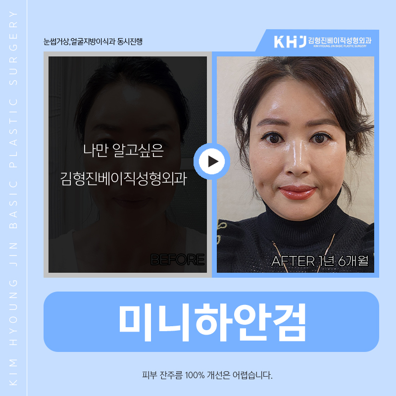 효도성형으로 젊음을 되찾아드리고 싶다면? 관련 이미지 4