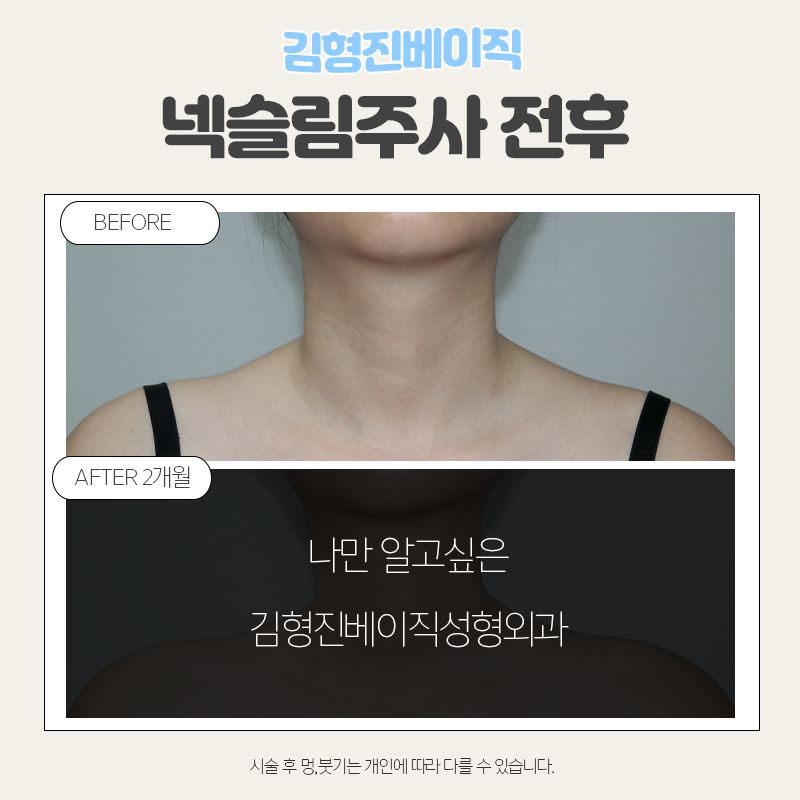 넥슬림주사시술이 궁금하시다면 관련 이미지 3