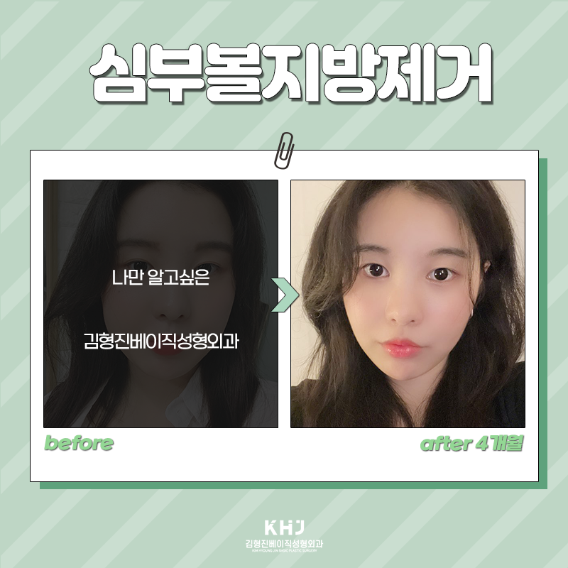 심부볼제거전후 후기 좋은 곳 찾으셨나요? 관련 이미지 3