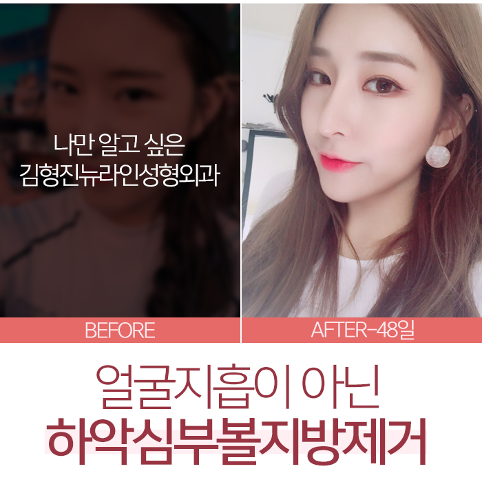 얼굴지흡 하기전에 이것부터 관련 이미지 6
