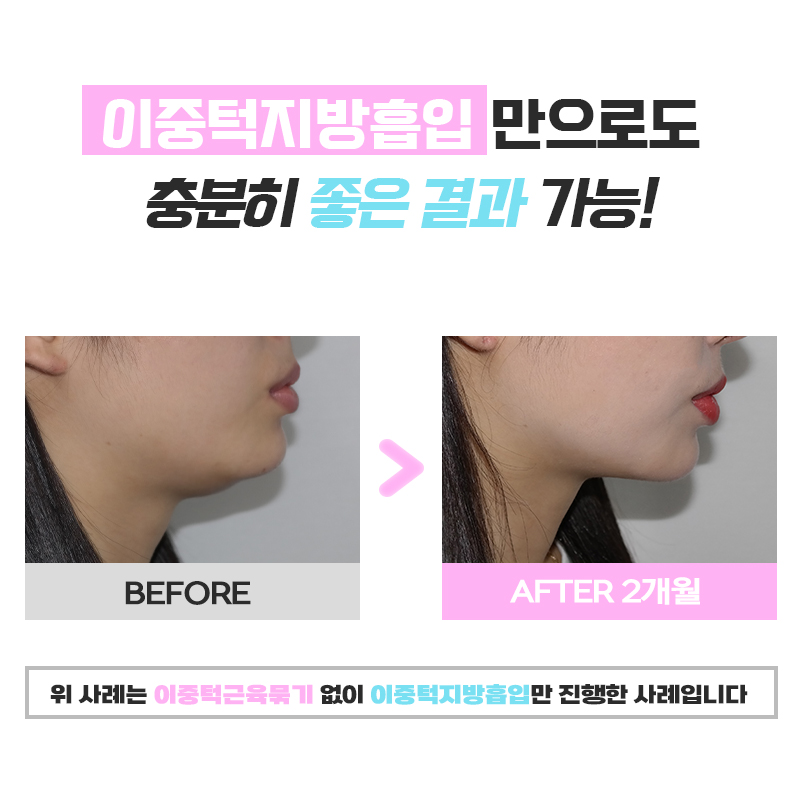 Completely Satisfied with My Chin Liposuction Resultsㅠㅠ image 6