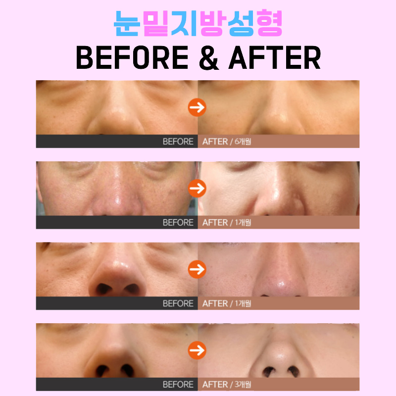 지저분한 눈 밑 지방, 압구정눈밑지로 해결! 관련 이미지 6