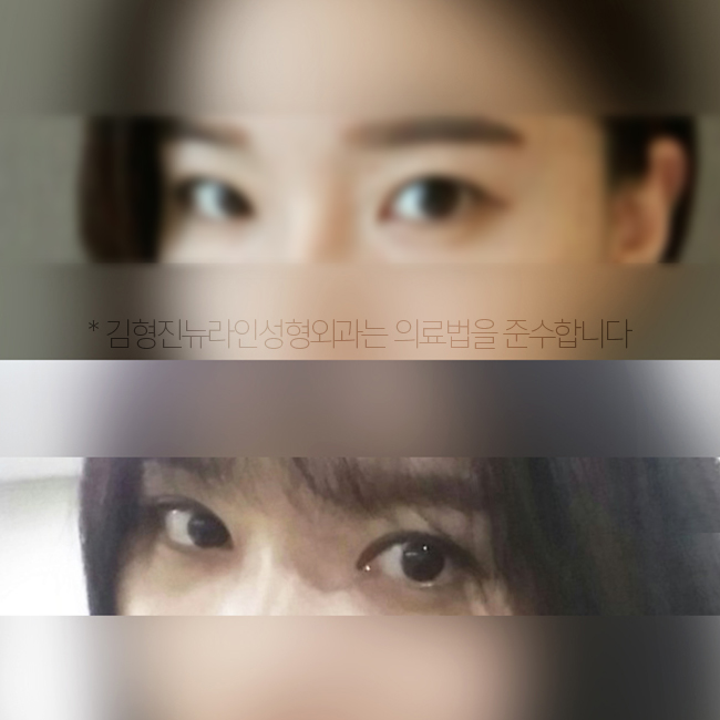학생 쌍수 후기 리얼로 보니 하고 싶잖아~ 관련 이미지 5