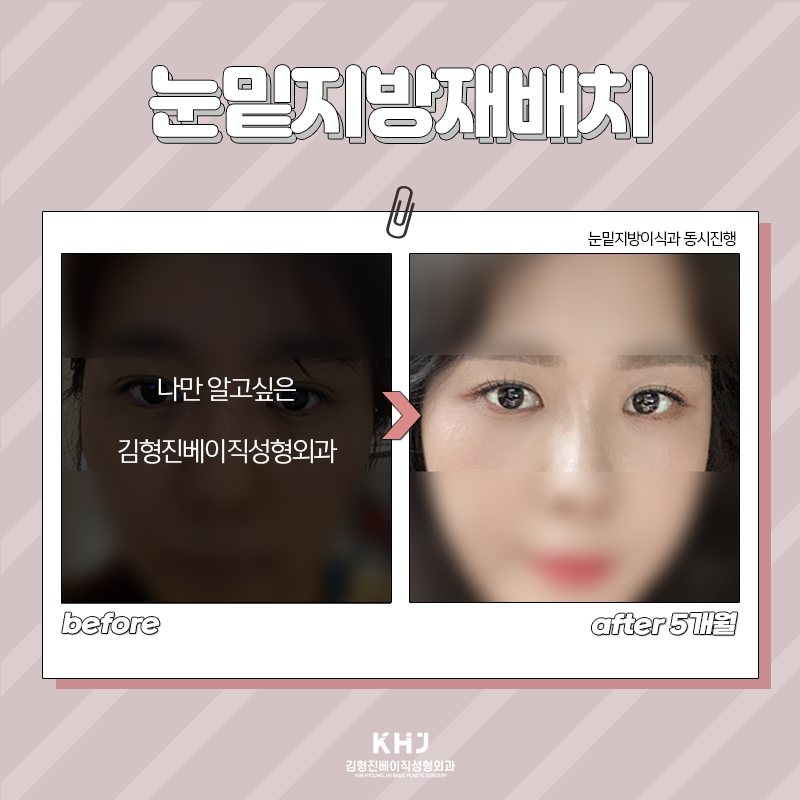 눈밑지방재배치재발 걱정하지 마세요! 관련 이미지 6