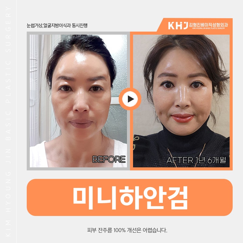 눈 밑 처짐, 미니하안검수술로 이제 가볍게 해결해요 관련 이미지 5