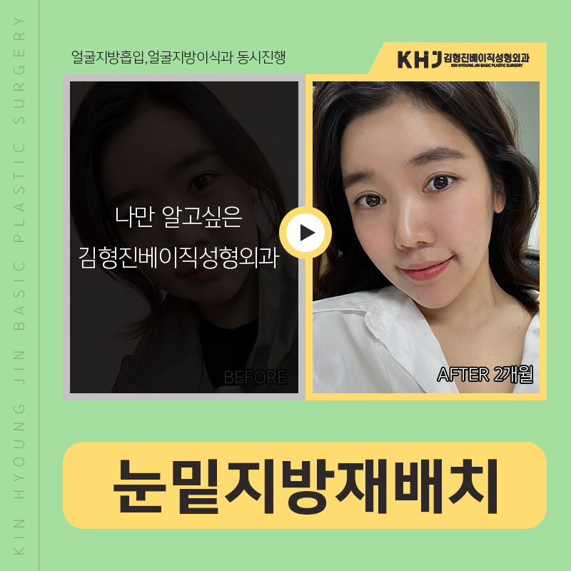눈밑지방재배치붓기 걱정되신다구요? 관련 이미지 6