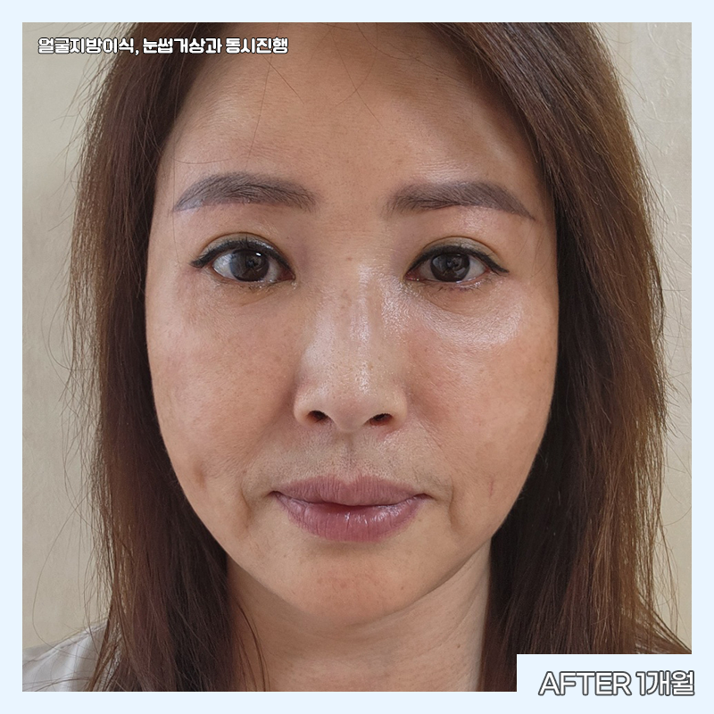 중년눈밑수술 김형진베이직에서 해야 하는 이유 관련 이미지 5