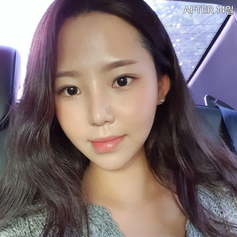 김형진베이직 얼굴지흡효과 좋다 좋아 관련 이미지 5