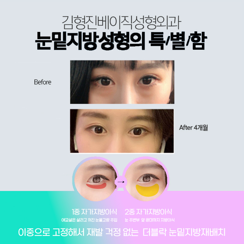 눈밑지방없애는방법 궁금하셨던 분들 들어오세요! 관련 이미지 4