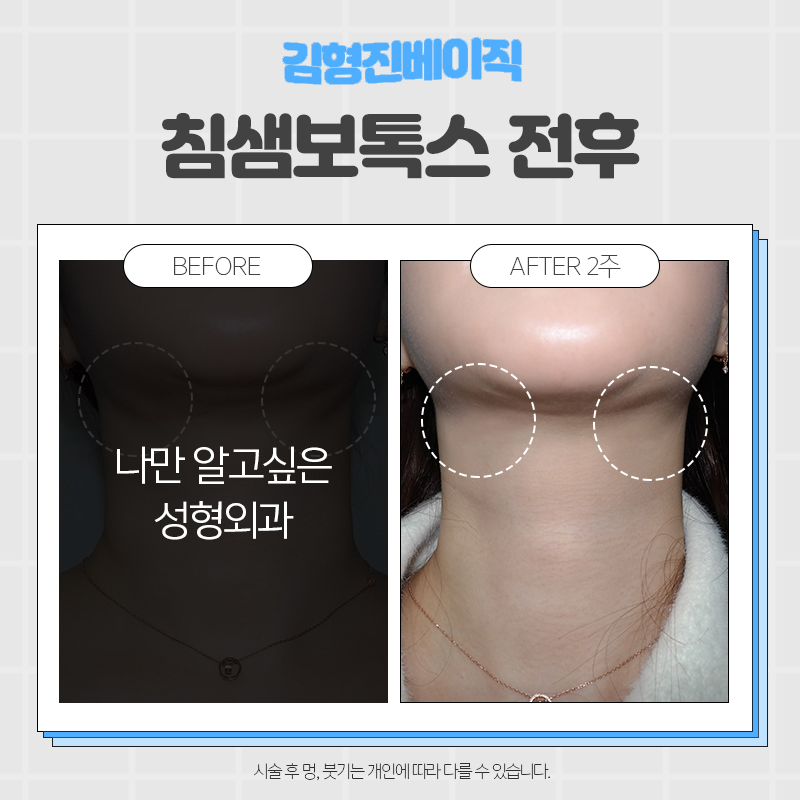 강남침샘보톡스 살을 빼도 턱선을 찾을 수 없다면? 관련 이미지 6
