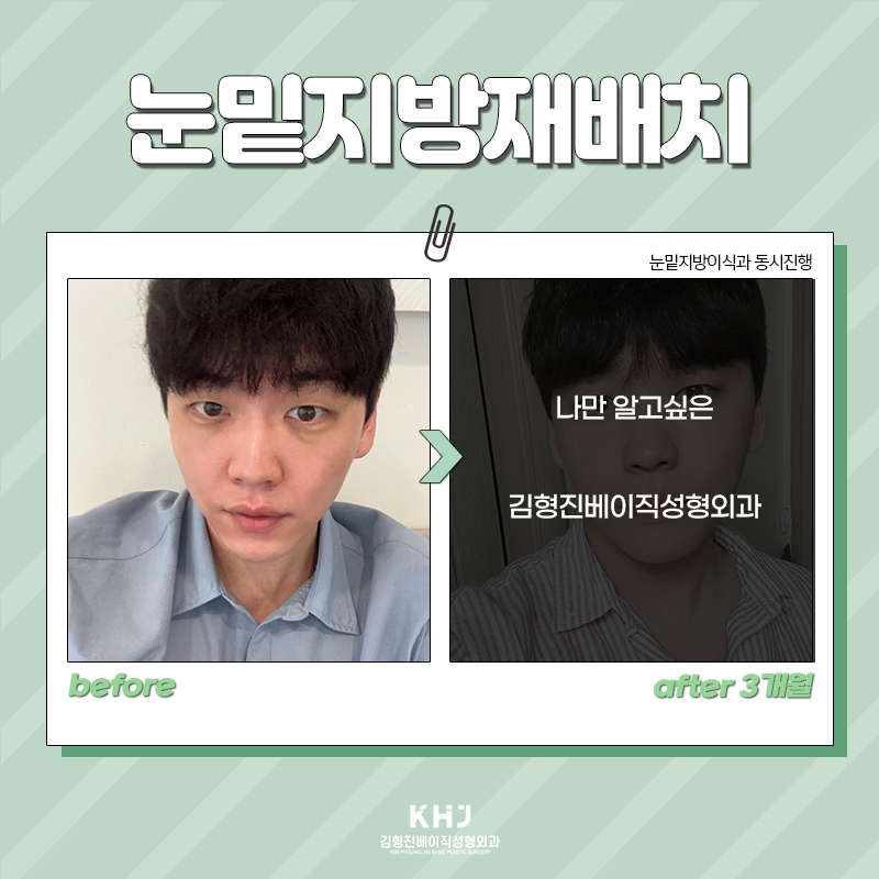 눈밑지방재배치전후 보고 가세요! 관련 이미지 3