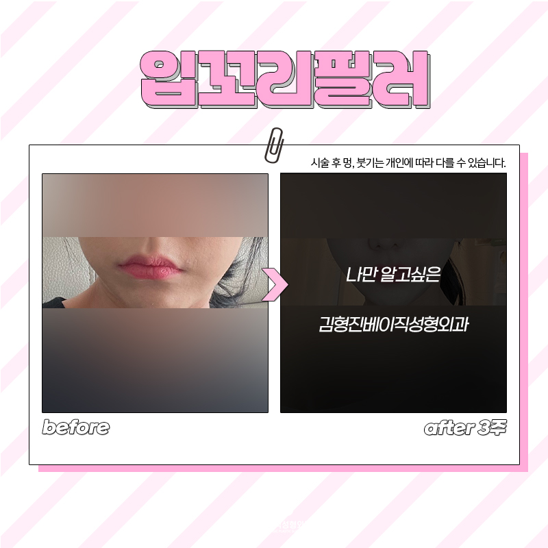 입꼬리교정을 통해 웃는 인상 완성해요 관련 이미지 5