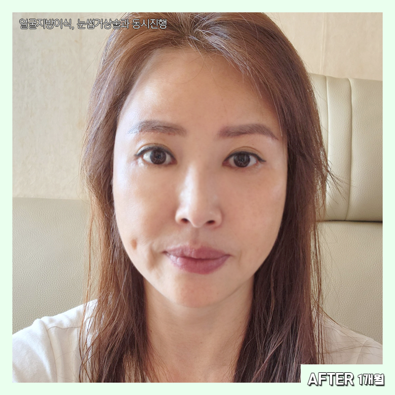 미니하안검붓기 궁금하셨다구요? 관련 이미지 5