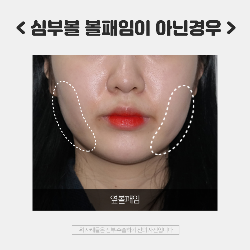 심부볼 볼패임 김형진에서는 걱정 없는 이유! 관련 이미지 6