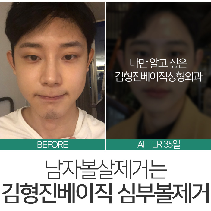 남자볼살제거 어설프게 말고 관련 이미지 4