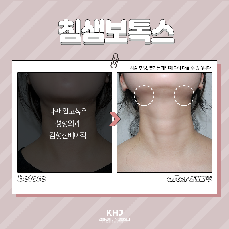 침샘보톡스유지기간 확인하세요! 관련 이미지 4