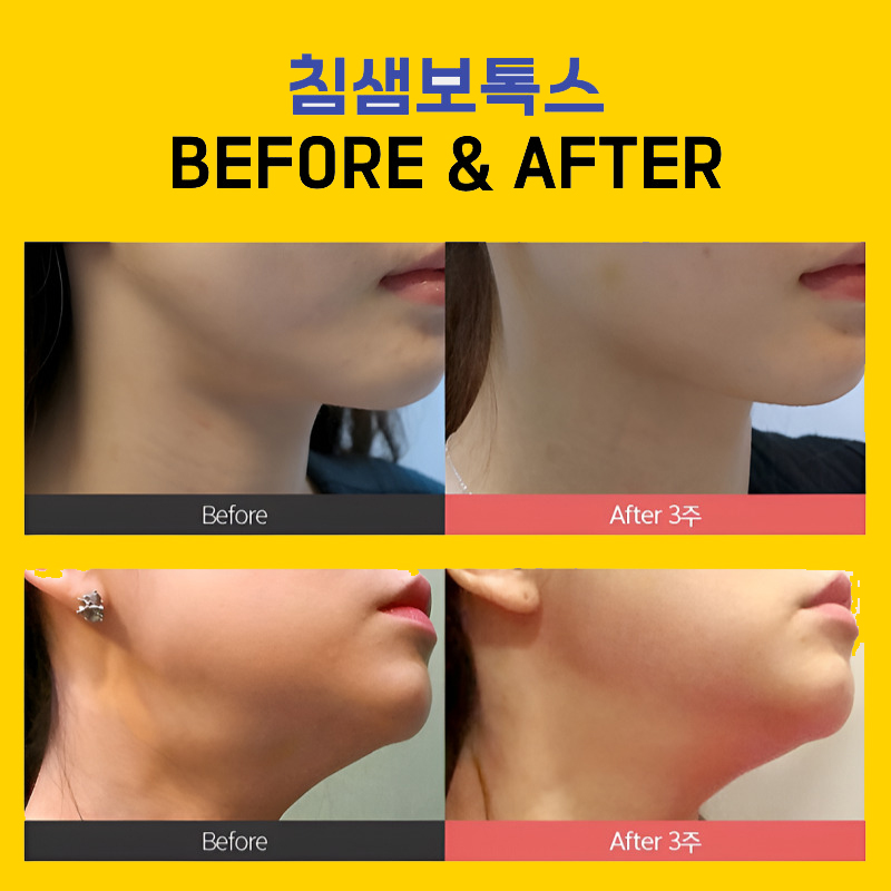 침샘보톡스시술로 슬림한 하관 만들기! 관련 이미지 5