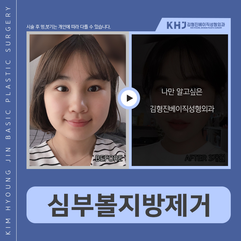 심부볼윤곽주사 과연 효과 있을까요? 관련 이미지 4