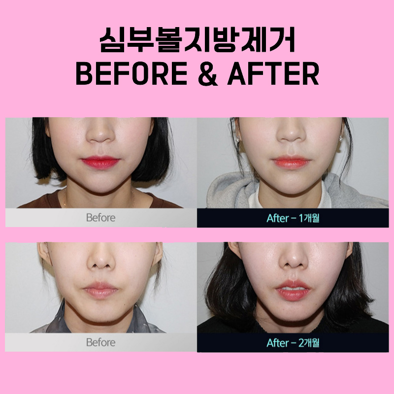 심부볼제거후기 직접 눈으로 보고 결정하세요 관련 이미지 5