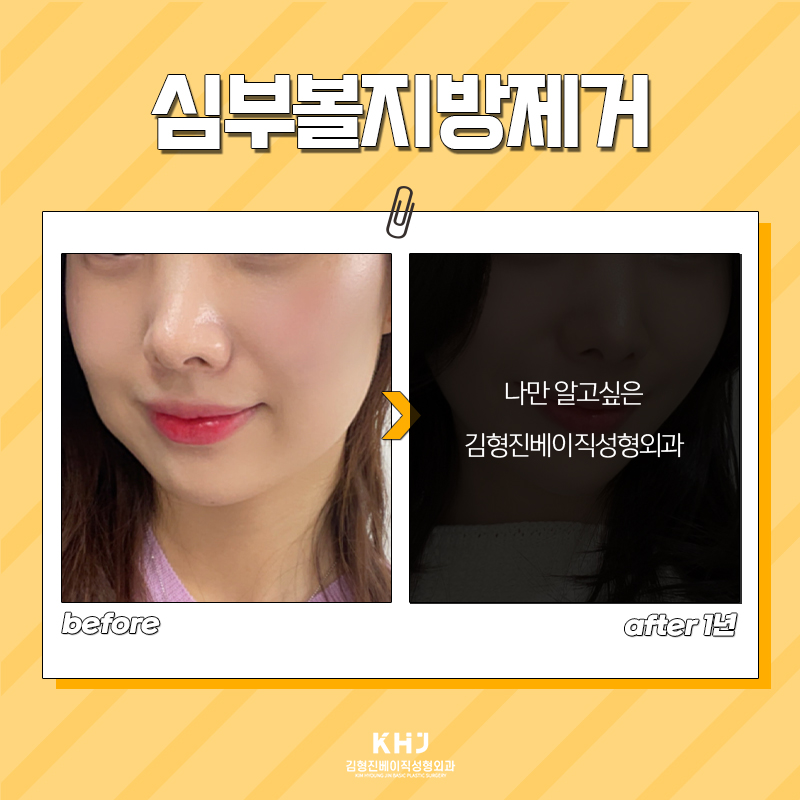 나만 알고 싶던 심부볼없애는방법 언제 글 내릴지 몰라요 관련 이미지 5
