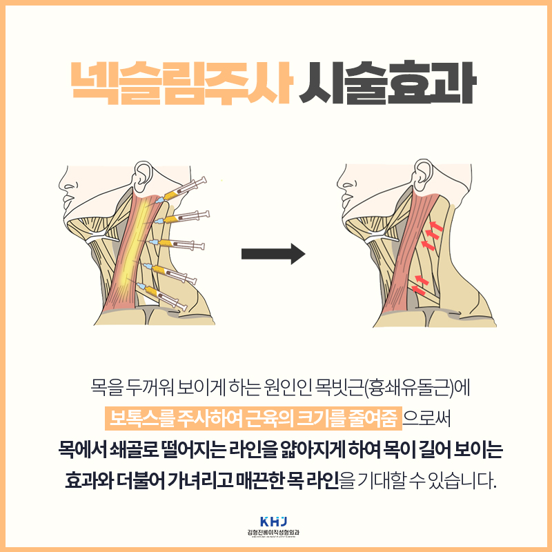 목얇아지는시술 넥슬림주사로 옷핏이 완전 달라졌어요 관련 이미지 4
