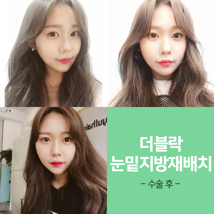 눈밑지방재배치멍 걱정? 김형진원장이라면 관련 이미지 6