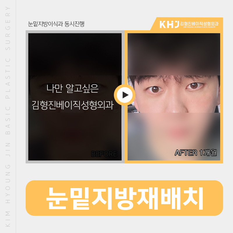 눈밑지방재배치레이저 티 안나게 해야죠 관련 이미지 4