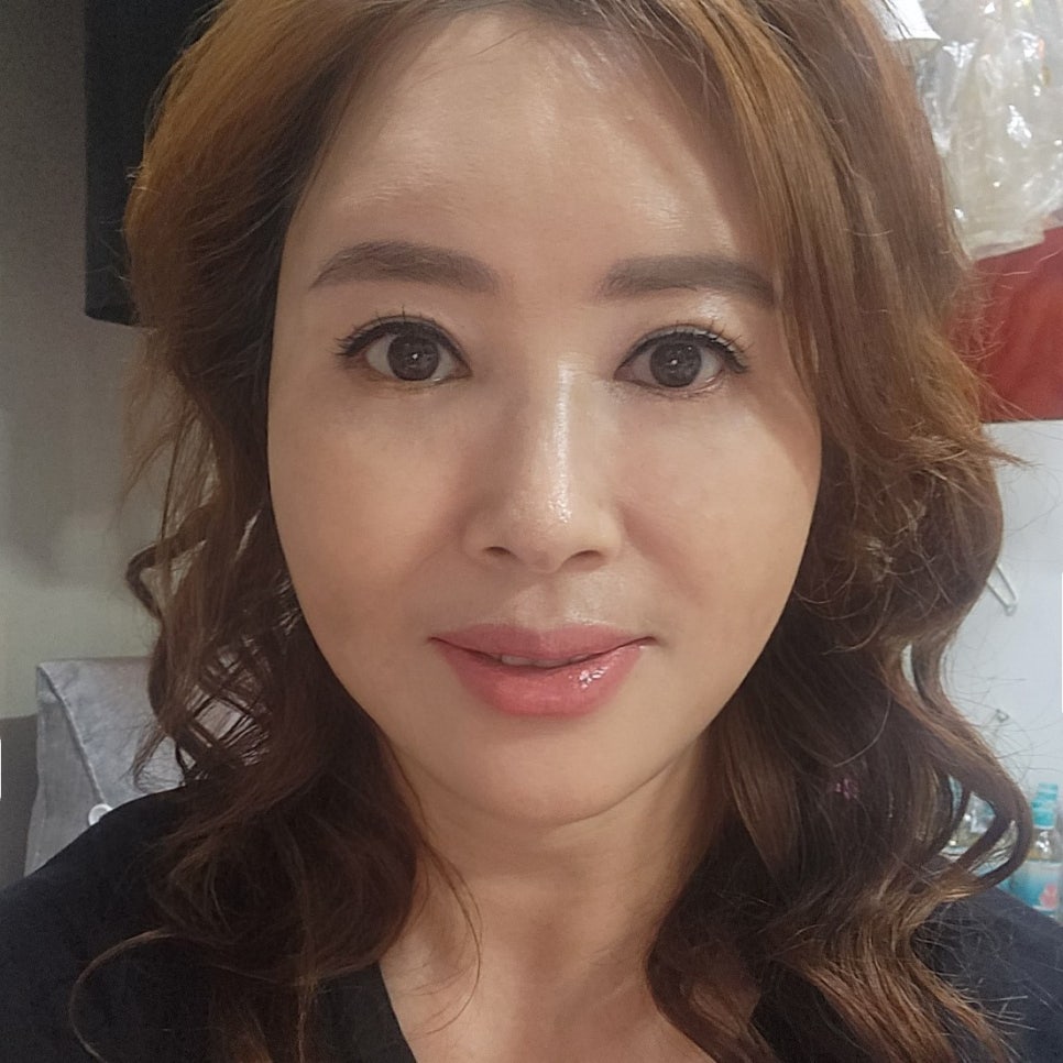 What Is the Difference Between Mini Lower Blepharoplasty and Under-Eye Fat Repositioning? image 2