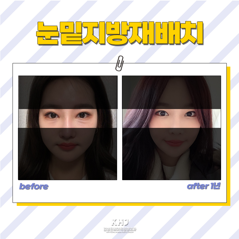 하루만에 눈밑지방없애는법, 이렇게 하면 됩니다 관련 이미지 5