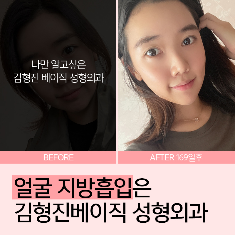 아큐스컬프로 얼굴살 깔끔하게 해결 관련 이미지 2