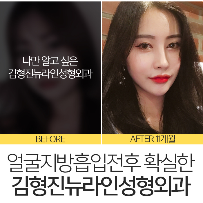 얼굴지방흡입전후 제대로 보려면 관련 이미지 7