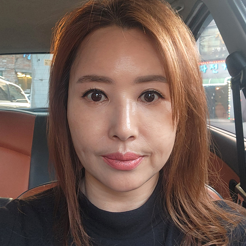 미니하안검회복기간 어느정도냐구요? 관련 이미지 1