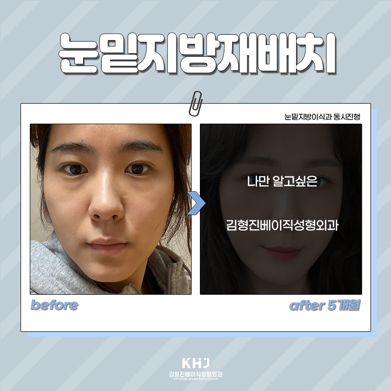 눈밑지방재배치수술 이젠 하셔야죠! 관련 이미지 5