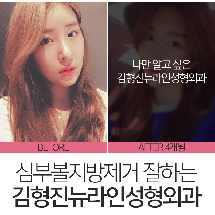 압구정심부볼제거 남다른 후기 관련 이미지 6