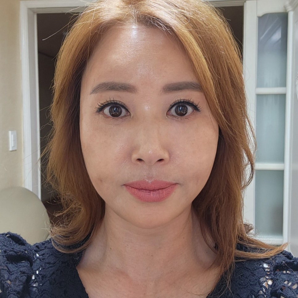 미니하안검은 반드시 중년눈성형잘하는곳에서 관련 이미지 2