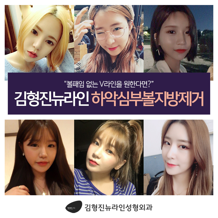 하악심부볼지방제거 볼패임을 잡다 관련 이미지 5