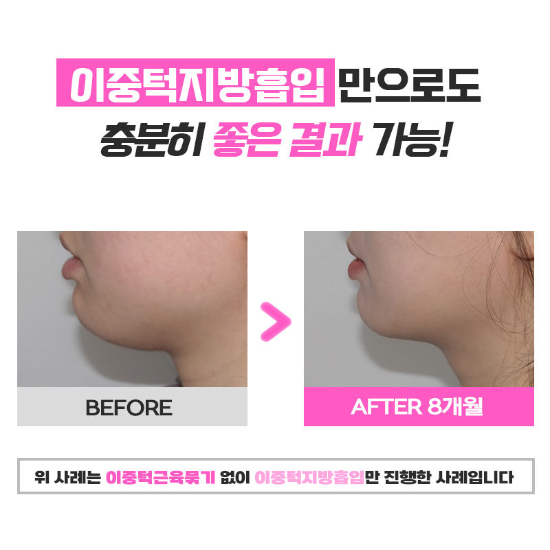 아는 사람들은 다 아는 진짜 턱살없애는법 관련 이미지 6